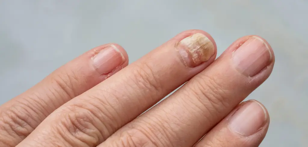 Laser Fungal Nail Treatment